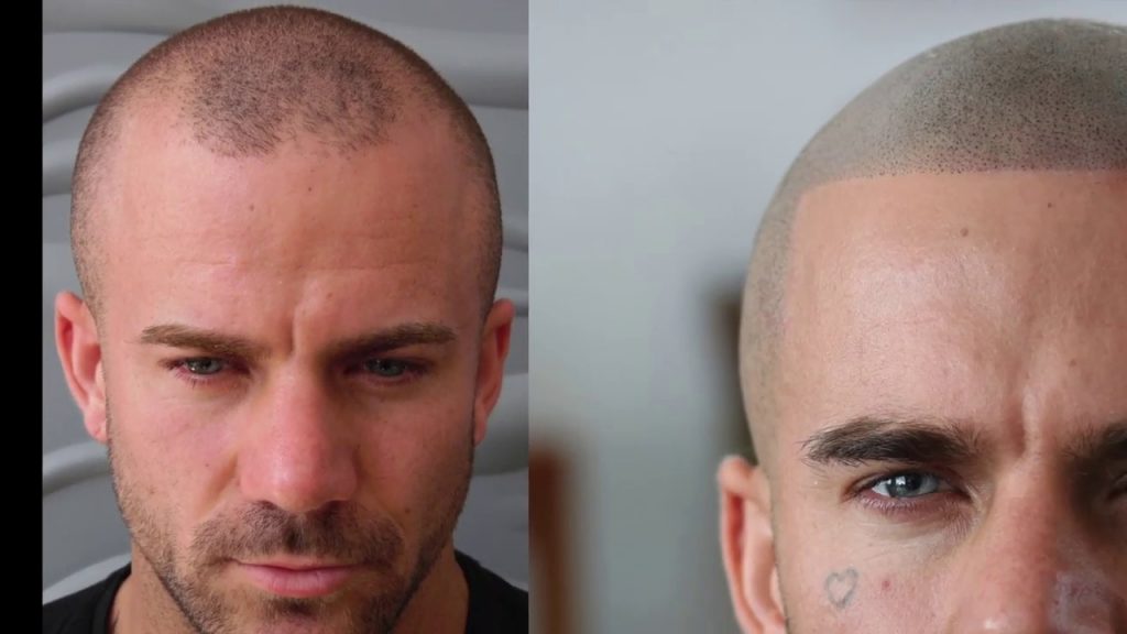 Is scalp micro-pigmentation Los Angeles, a hair tattoo?